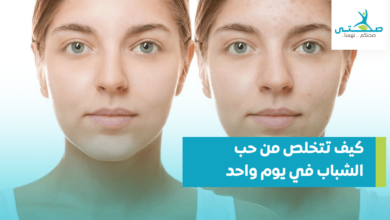 كيف تتخلص من حب الشباب في يوم واحد