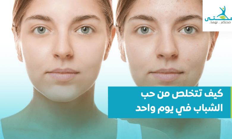 كيف تتخلص من حب الشباب في يوم واحد