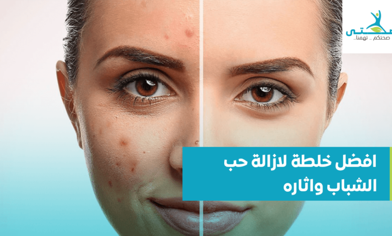 افضل خلطة لازالة حب الشباب واثاره
