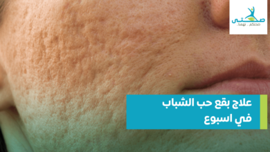 علاج بقع حب الشباب في اسبوع