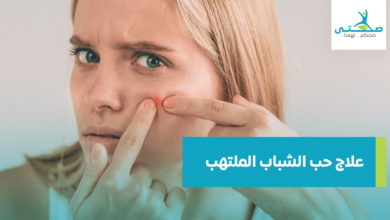 علاج حب الشباب الملتهب