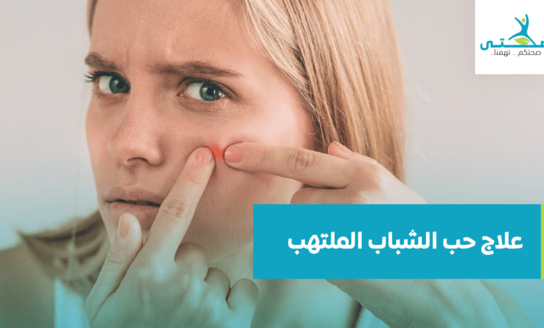 علاج حب الشباب الملتهب