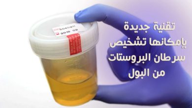 تشخيص سرطان البروستات من البول
