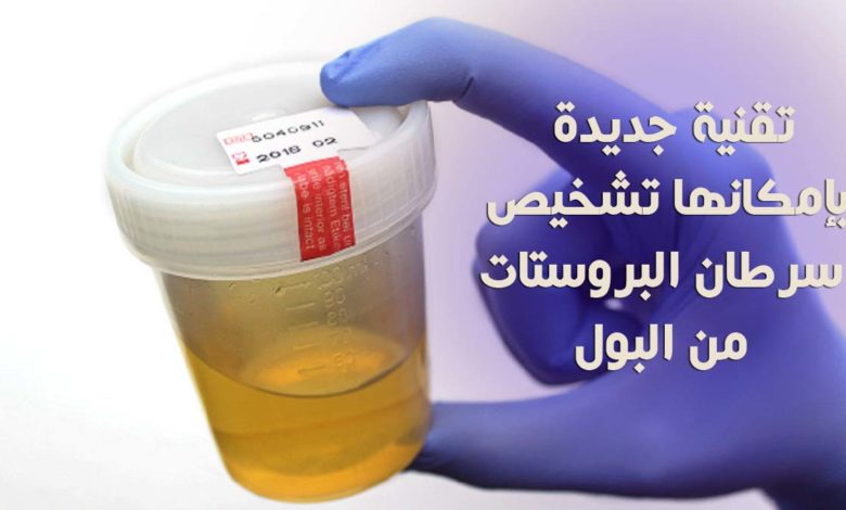 تشخيص سرطان البروستات من البول
