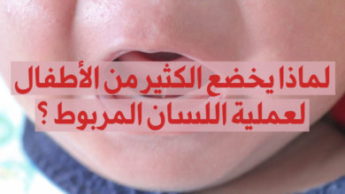 الأطفال وعملية اللسان المربوط