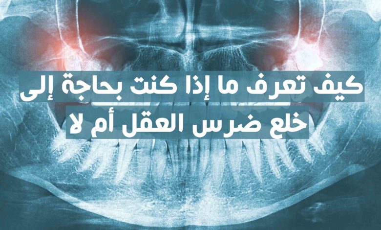 خلع ضرس العقل