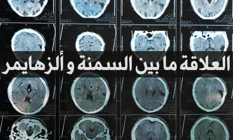 العلاقة ما بين السمنة و ألزهايمر