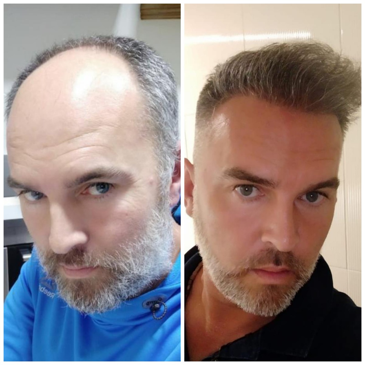 قبل وبعد عمليات زراعة الشعر