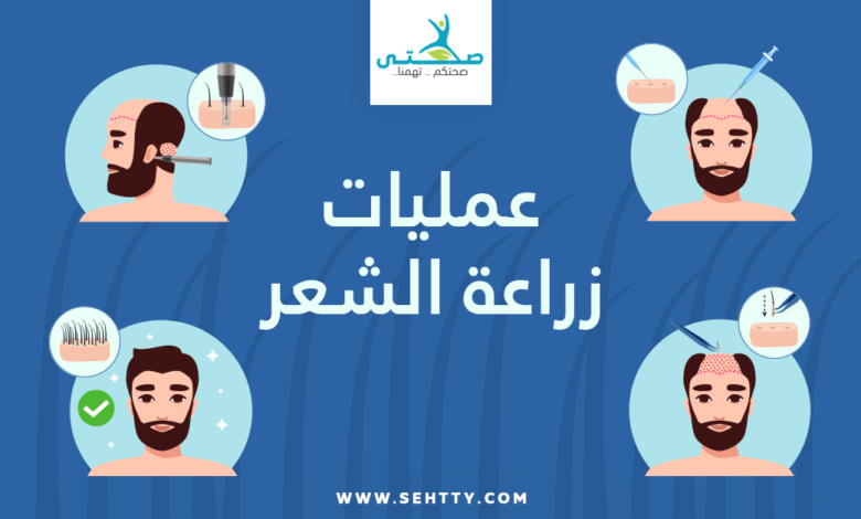 عمليات زراعة الشعر