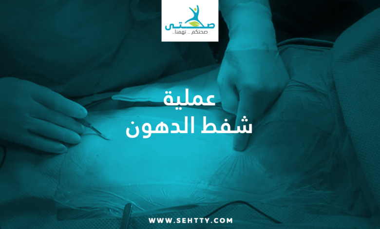 عملية شفط الدهون
