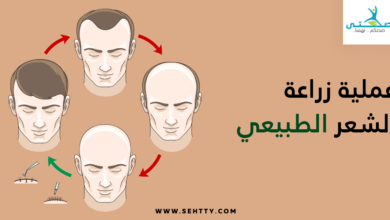 عملية زراعة الشعر الطبيعي