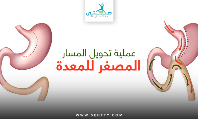تحويل المسار المصغر للمعدة