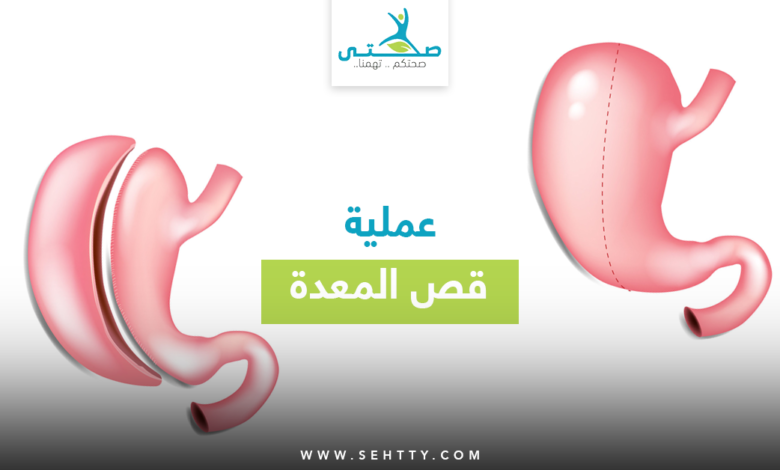 عملية قص المعدة