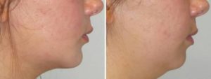عملية تجميل الوجه بواسطة تكبير الذقن