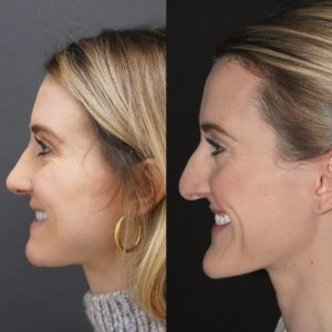 عملية تجميل الوجه وتصغير الذقن