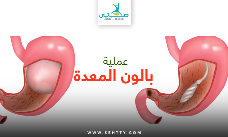 عملية بالون المعدة
