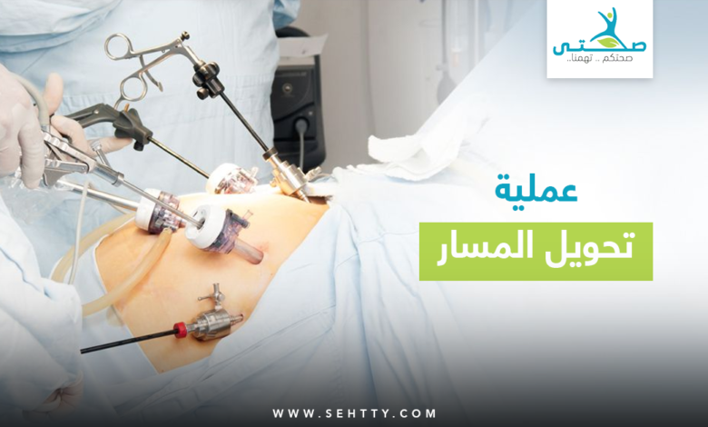 عملية تحويل المسار للمعدة