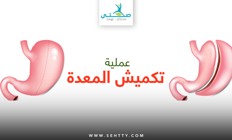 عملية تكميش المعدة