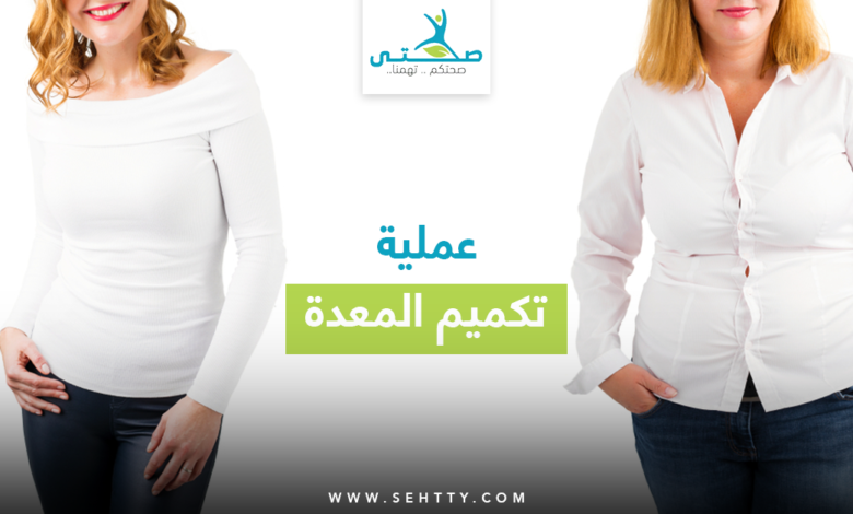 عملية تكميم المعدة