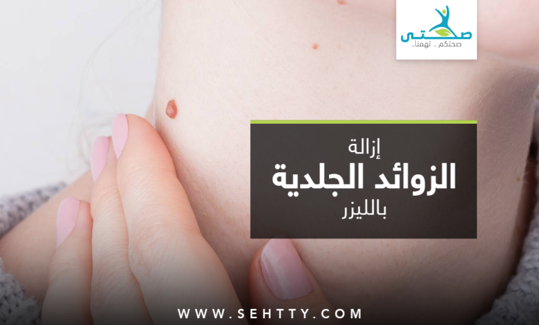 إزالة الزوائد الجلدية بالليزر