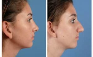 طريقة عملية تجميل الأنف