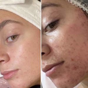 وسائل عملية تجميل الوجه وإزالة الندبات