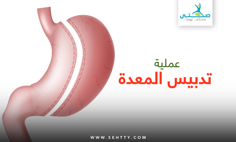 عملية تدبيس المعدة