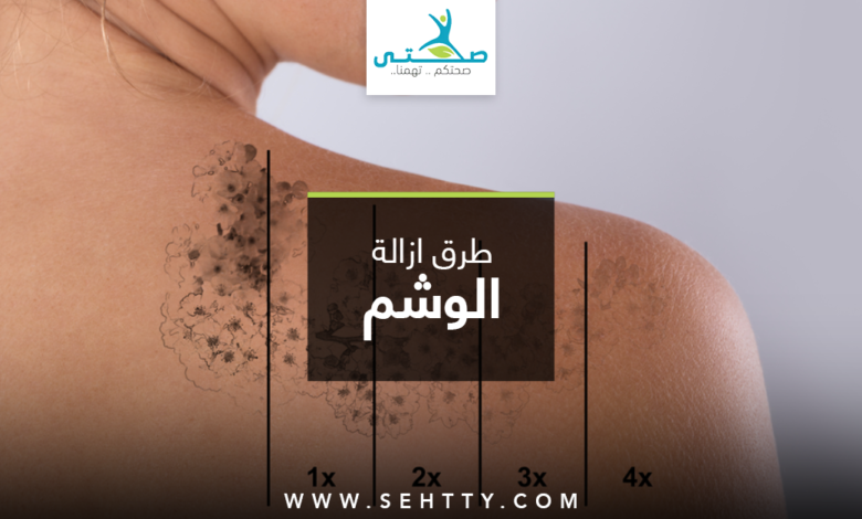 ازالة الوشم