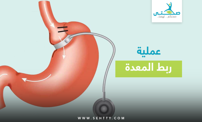 عملية ربط المعدة