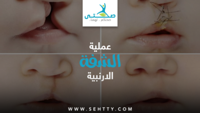الشفة الارنبية