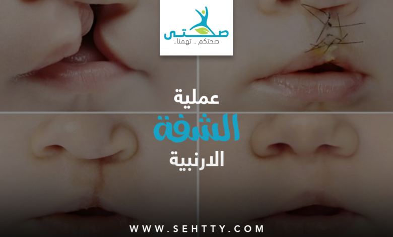 الشفة الارنبية