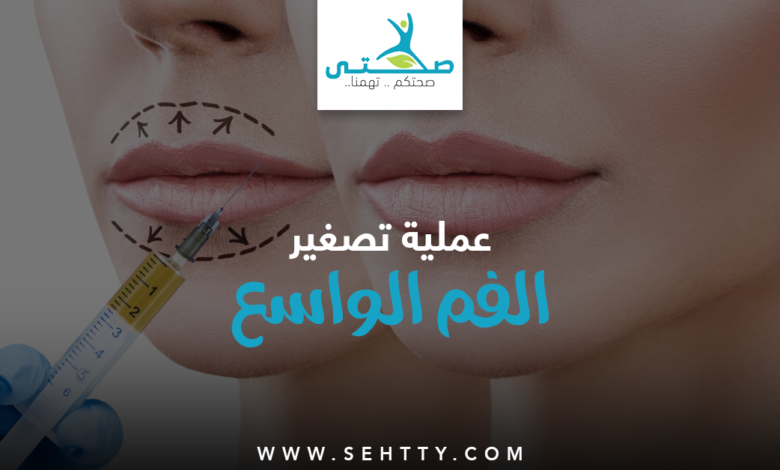 عملية تصغير الفم الواسع