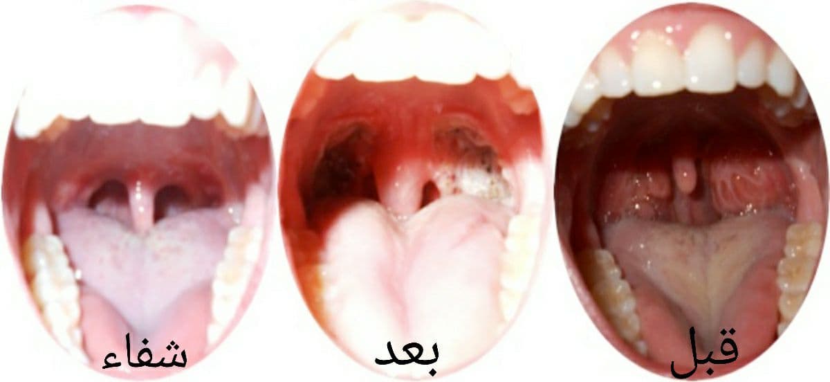 علاج اللحمية عند الاطفال