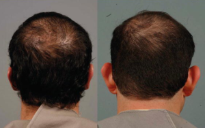 شكل الأذن قبل وبعد إجراء عملية تجميل الاذن بالليزر