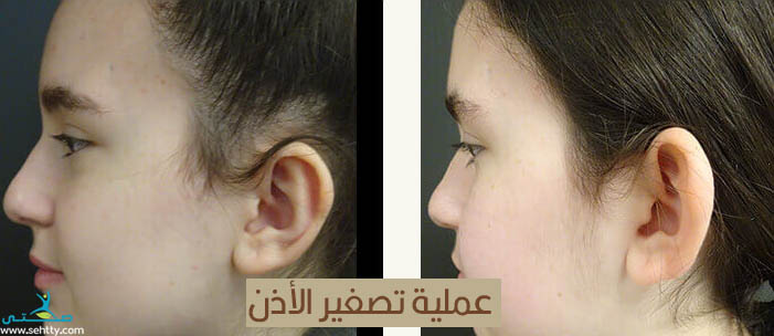 عمليّة تصغير الأذن