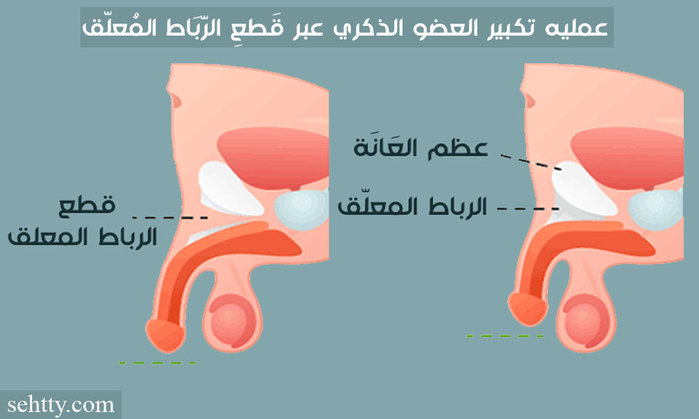 عمليه تكبير العضو الذكري عبر قَطعِ الرّبَاط المُعلّق