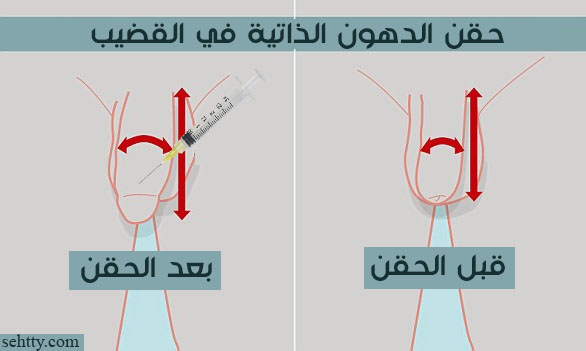 عملية تكبير العضو الذكري عبر حَقن الدّهون