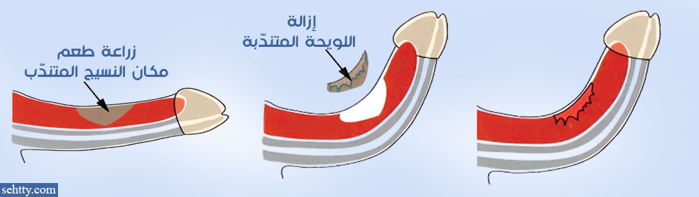 عملية جراحية لجعل جانب القضيب المنحني أطول