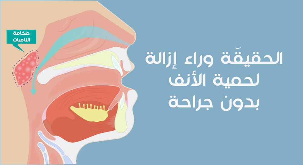 الحقيقَة وراء إزالة لحمية الأنف بدون جراحة
