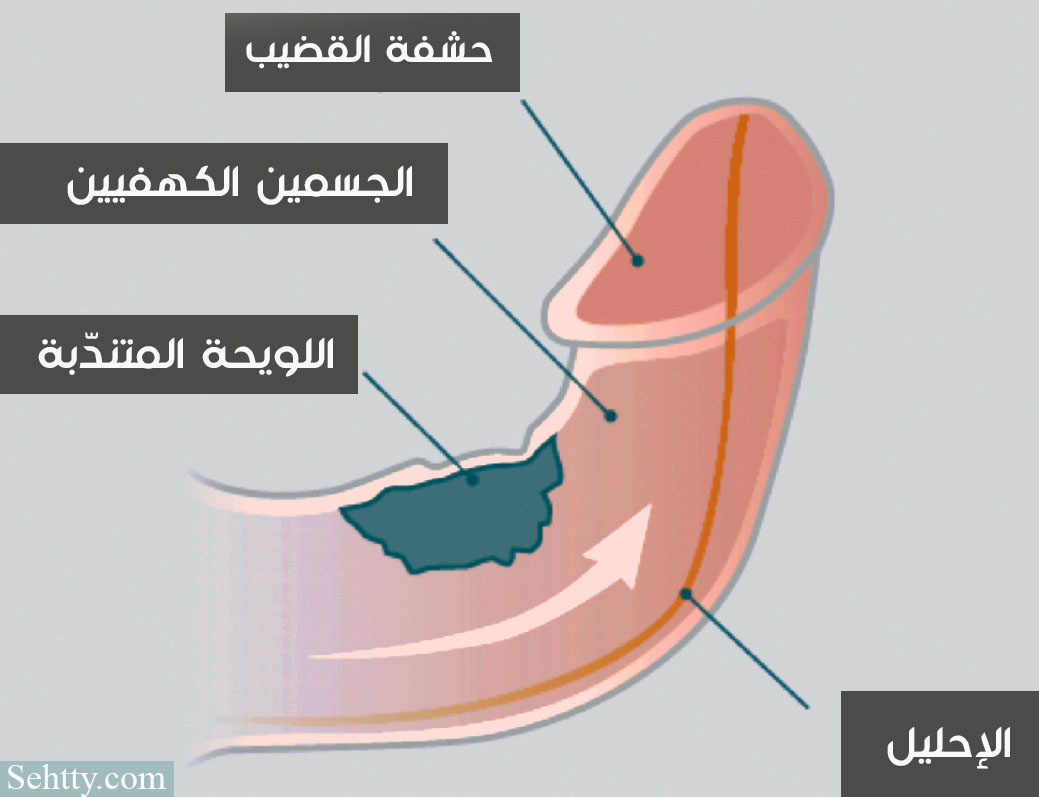 تشريح لعضو ذكري مصاب بمرض بيروني