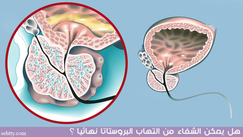 هل يمكن الشفاء من التهاب البروستاتا نهائيا ؟