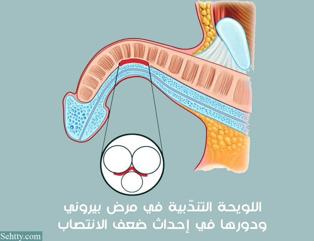 ضعف الانتصاب ومرض بيروني