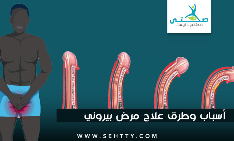 أسباب، أعراض، وطرق علاج مرض بيروني