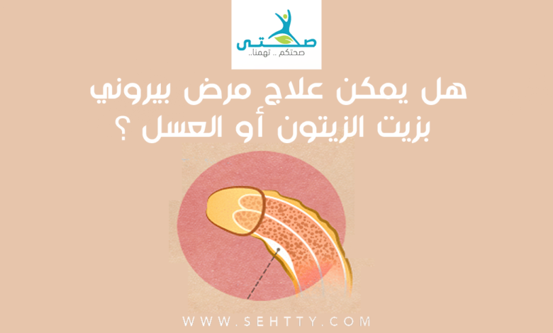 هل يمكن علاج مرض بيروني بزيت الزيتون أو العسل ؟
