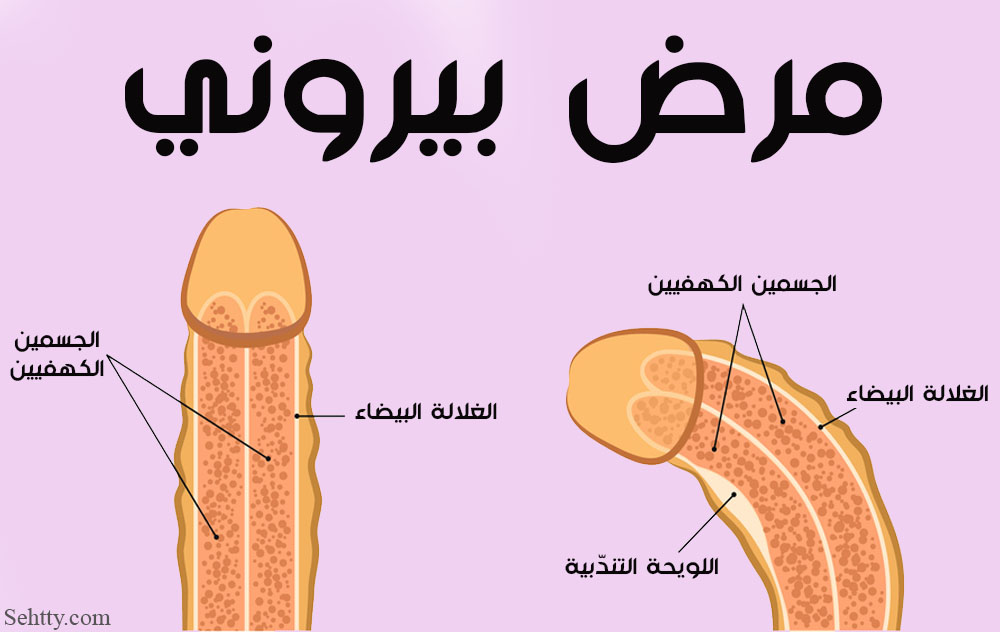 ما هو مرض بيروني ؟
