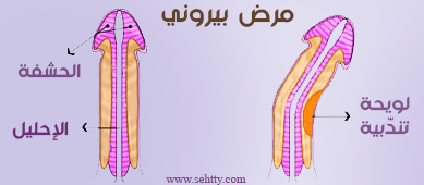 ما هُو مرَض بيروني ؟