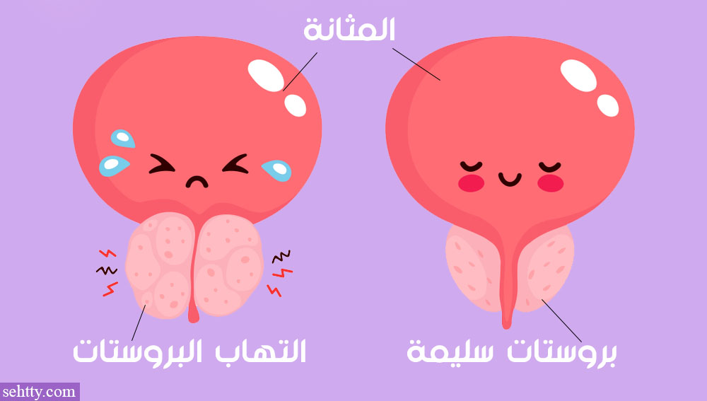 ما هو التهاب البروستاتا ؟
