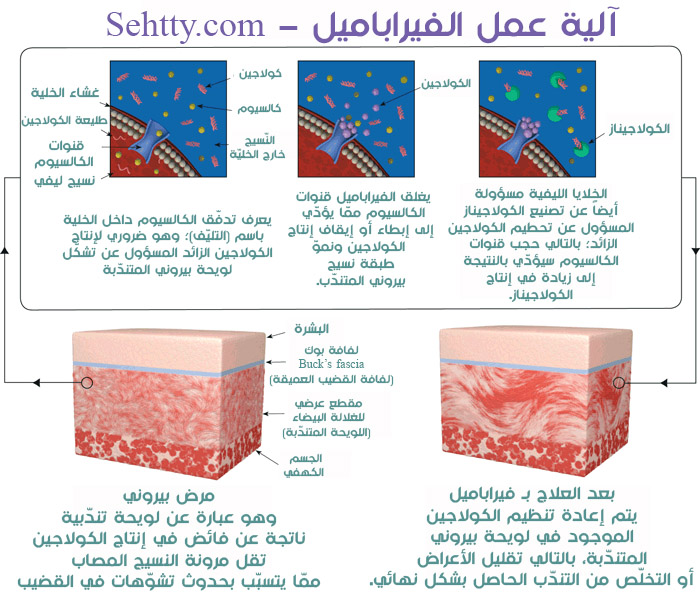 آلية عمل فيراباميل من مراهم لعلاج مرض بيروني