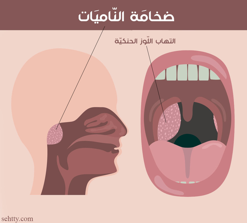 ما هِي لحميّة الأنف ؟