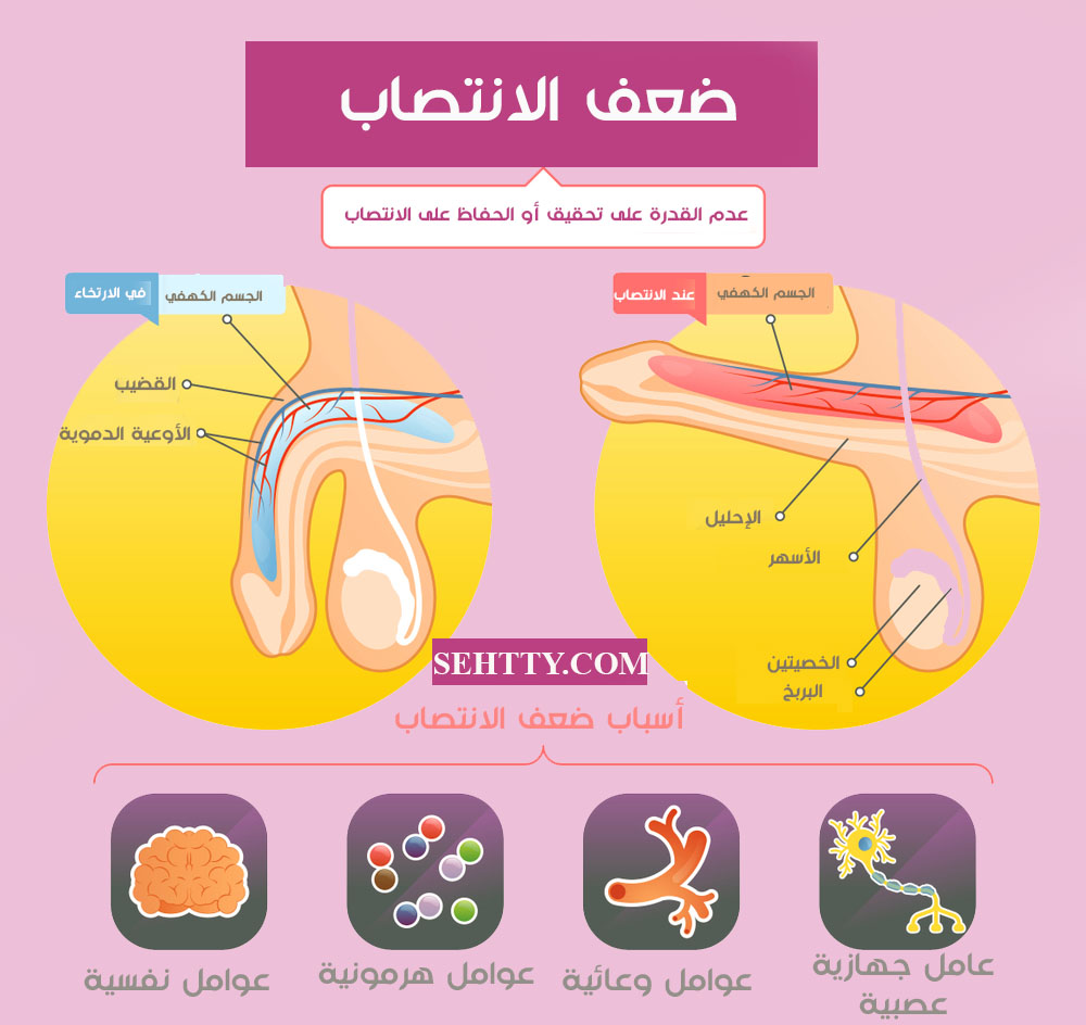 أسباب ضعف الانتصاب